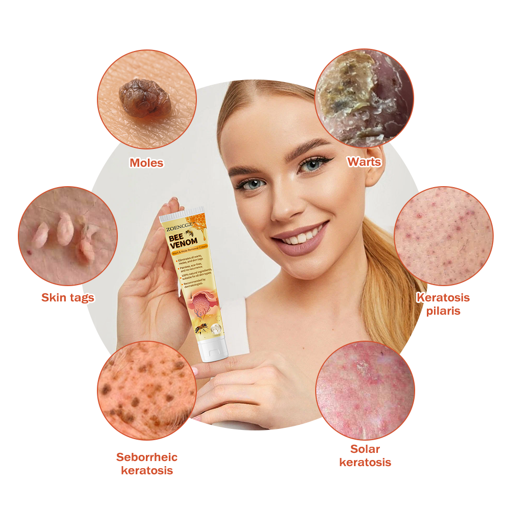 𝗭𝗼𝗲𝗻𝗰𝗴𝘇™ 𝗕𝗲𝗲 𝗩𝗲𝗻𝗼𝗺 𝗠𝗼𝗹𝗲 𝗮𝗻𝗱 𝗪𝗮𝗿𝘁 𝗧𝗿𝗲𝗮𝘁𝗺𝗲𝗻𝘁 𝗖𝗿𝗲𝗮𝗺