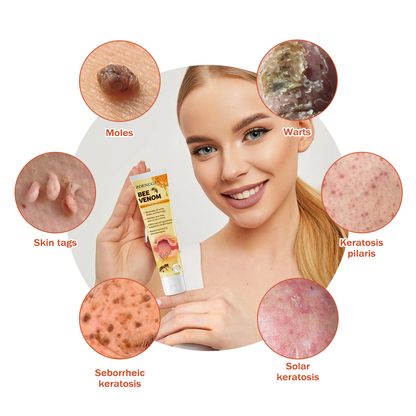 𝗭𝗼𝗲𝗻𝗰𝗴𝘇™ 𝗕𝗲𝗲 𝗩𝗲𝗻𝗼𝗺 𝗠𝗼𝗹𝗲 𝗮𝗻𝗱 𝗪𝗮𝗿𝘁 𝗧𝗿𝗲𝗮𝘁𝗺𝗲𝗻𝘁 𝗖𝗿𝗲𝗮𝗺